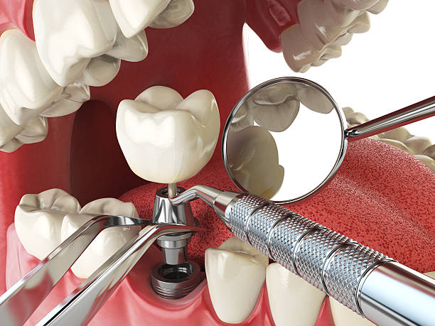 Best Dental Abscess Treatment in Orion, IL